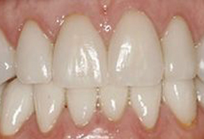 North Bellmore Dental Associates, PC | Inlays  amp  Onlays, Implant Dentistry and Crowns  amp  Caps