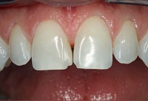 North Bellmore Dental Associates, PC | Dental Fillings, Bonding and Extractions